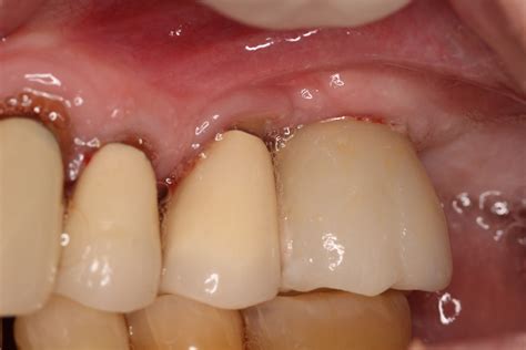 Allergy & Titanium Dental Implants- OKC - Ryan Lanman DDS, MSD