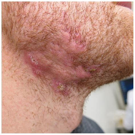 Hidradenitis Suppurativa Stages: Determining The Severity, 45% OFF