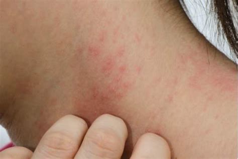 Itchy Skin Rash After Surgery Causes Diagnosis Treatment