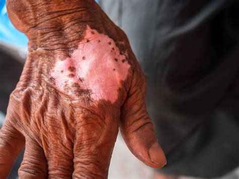 World Leprosy Day: 10 points about this bacteria-driven treatable illness | Health Tips and News