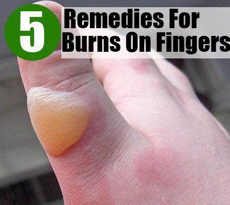 Top 5 Home Remedies For Burns On Fingers (With images) | Home remedies for burns, Burn remedy ...