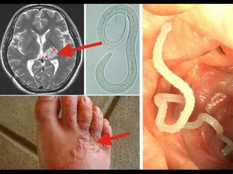 Internal Parasites Are They Eating You Alive? | Yeast infection, Recurring yeast infections ...