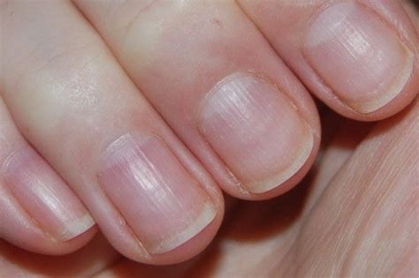 Ridged nails? Here’s why – and how to treat them – Scratch