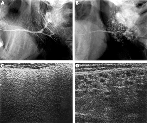 Sonography as a replacement for sialography for the diagnosis of salivary glands affected by ...