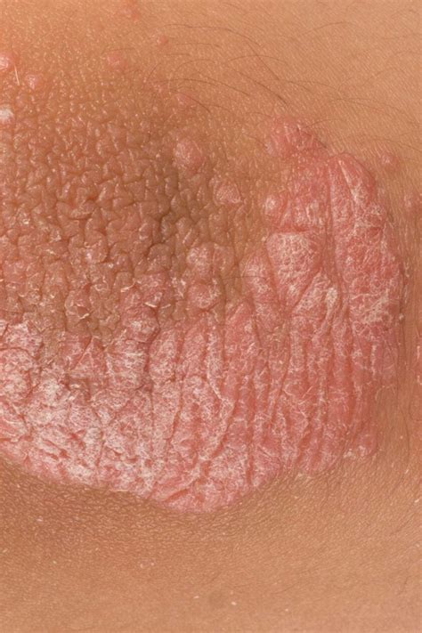 Psoriasis: What are the signs and symptoms?