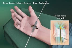 Open Carpal Tunnel Release Surgery Coral Springs, FL | Hand Surgeon ...