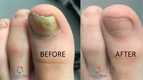 Fungal Nail Treatment | Health First Southam Foot & Gait Clinic