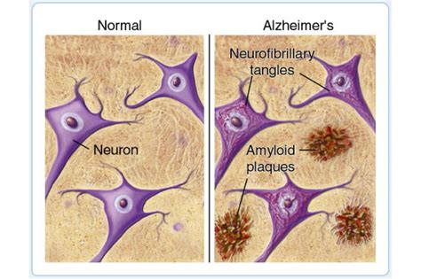 Resurrecting Tau in the Search for an Alzheimer’s (and Potentially ...