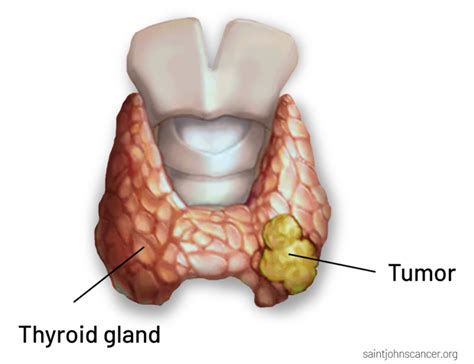 Thyroid Cancer Symptoms, Diagnosis, Surgery, Treatment, and Prognosis | Saint John’s Cancer ...