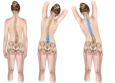 What Is Schroth Therapy For Scoliosis? | Westside Children's Therapy