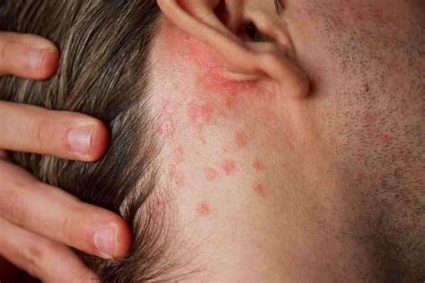 Stress skin rash: the triggers - Breaking Latest News