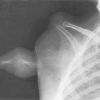 (PDF) The Classification of Phocomelia