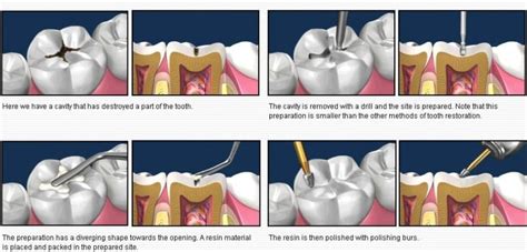 COMPOSITE FILLING - DocDentalSmile