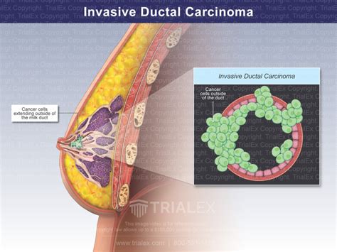 Invasive Ductal Carcinoma - Trial Exhibits Inc.