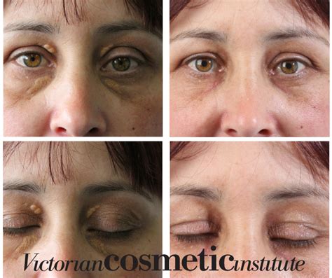 Surgery Xanthelasma Before And After - Goddess Healthy