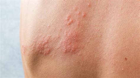 What Everyone Should Know About Shingles | Health Hive