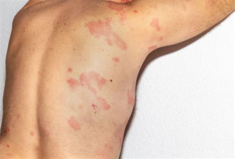 Rash Caused by Lamictal May Be a Sign of Drug Induced Hypersensitivity ...
