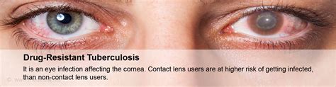 Acanthamoeba Keratitis - Symptoms, Signs, Diagnosis & Treatment