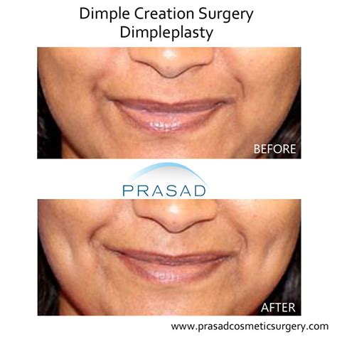 Dimple surgery | Dimple Creation | Learn More - New York