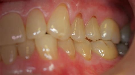 Tooth Abfraction Treatment