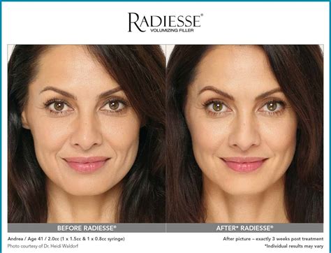 Radiesse Filler Injections - Chicago MedSpa & Aesthetics