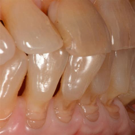 (PDF) Abfraction lesions: Etiology, diagnosis, and treatment options