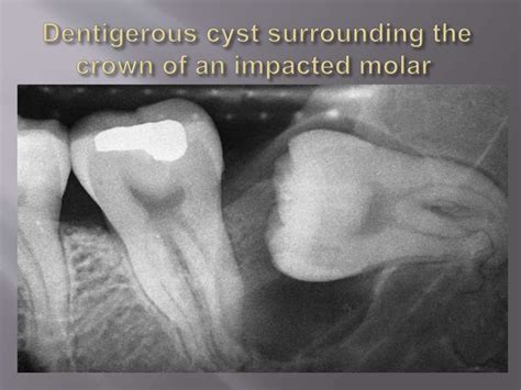 Odontogenic cysts