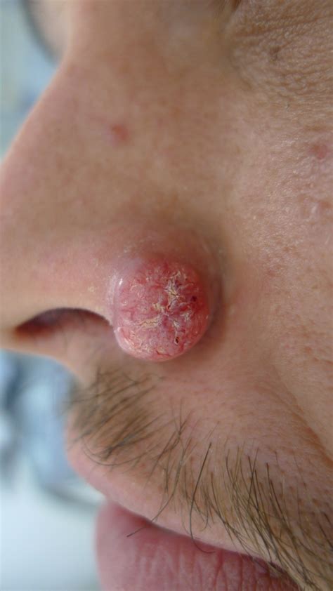 ACD A-Z of Skin - Keratoacanthoma