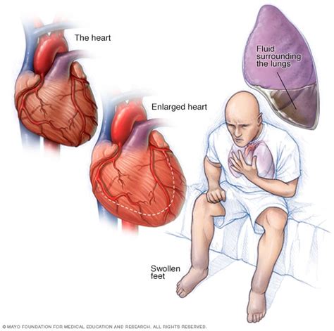 Heart failure - Symptoms and causes - Mayo Clinic