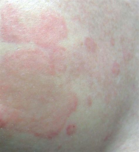 Fungus Rash On Chest Pictures Photos - vrogue.co
