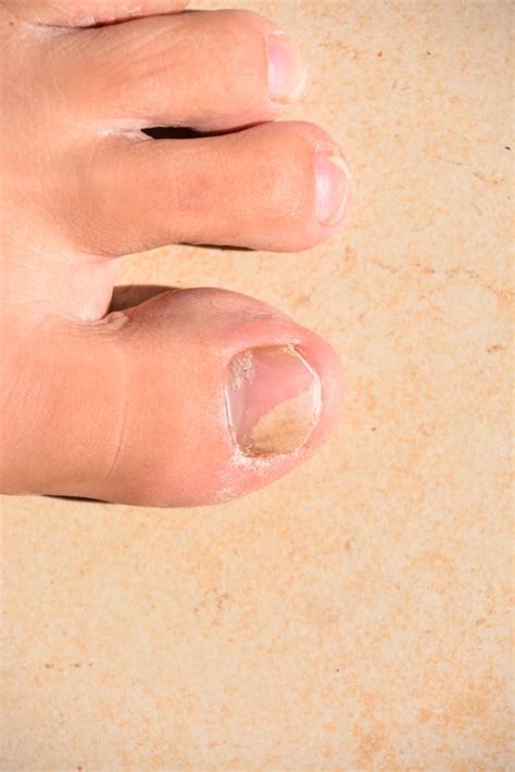 How to Tell if You Have a Toenail Fungus - Colorado Center of Orthopaedic Excellence