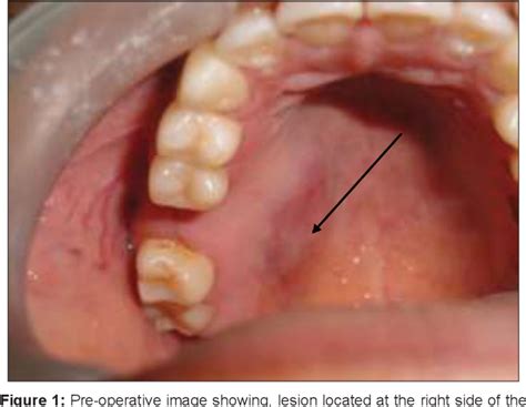 Mucoepidermoid Carcinoma of Palate: A Case Report | Semantic Scholar