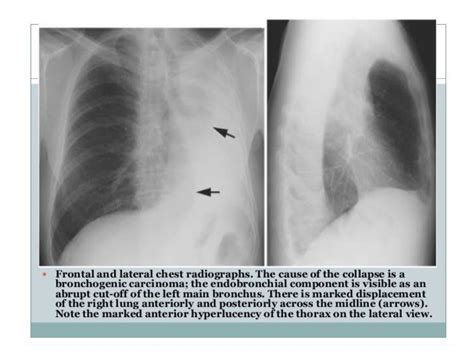 Collapse and consolidation Lung Radiology