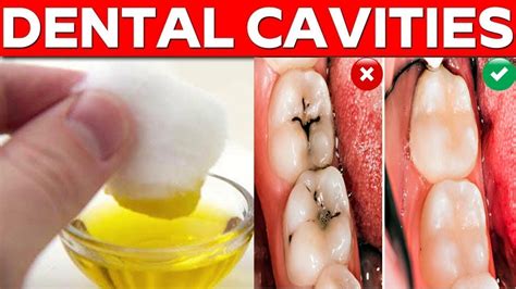 How Much To Fix A Cavity Without Insurance - Cmea