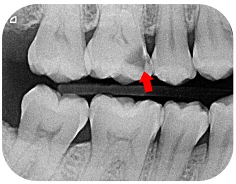 Why Do I Need X-Rays When I Visit the Dentist? - Twinkle Family Dentalcare