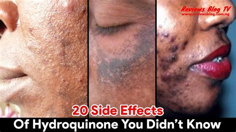 20 Side Effects Of Hydroquinone You Didn’t Know - YouTube