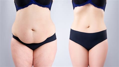 CoolSculpting vs. Liposuction {Cost, Results, Side Effects}