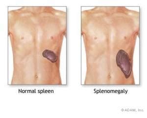 Enlarged Spleen - Symptoms, Causes, Diagnosis & Treatment - By Dr. Radhika A (Md) | Lybrate