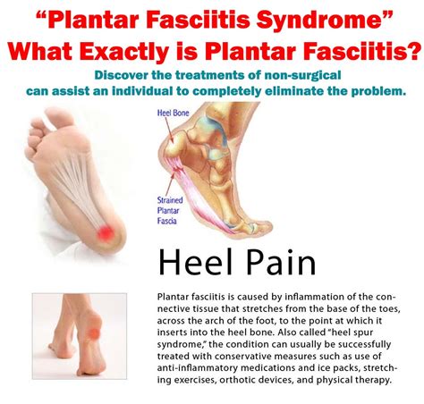 Fast and effective solution for painful heels: Plantar Fasciitis Syndrome - What Exactly is ...