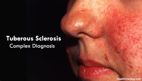 Tuberous Sclerosis Complex (TSC): Causes, Signs, Treatment, Diagnosis