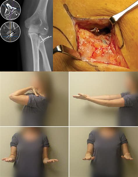 Functional Outcomes and Complications of Radial Head Fractures Treated with Screw Fixation