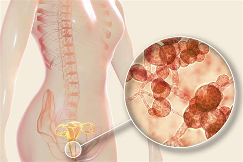 CE Activity | Vaginal Candidiasis | NPs