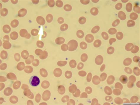 My patient with anemia has an abnormally high mean red blood cell ...