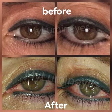 Lumineyes eye color change surgery — Turkey Eye Color Change Surgery | by Mylumineyes | Medium