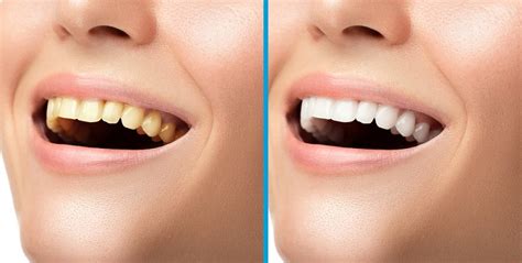 What Are Teeth Whitening Side Effects? - The Must-Know Truths - Dezy