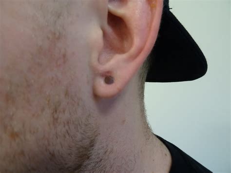 keloid ear after excision and reonstruction of peircing - James ...