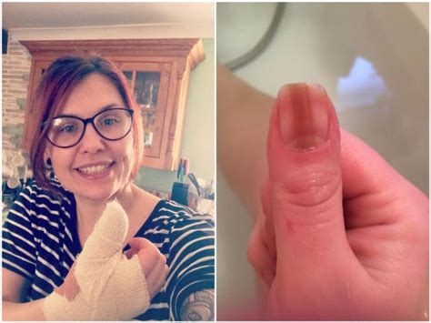 Line on woman's fingernail was sign of skin cancer