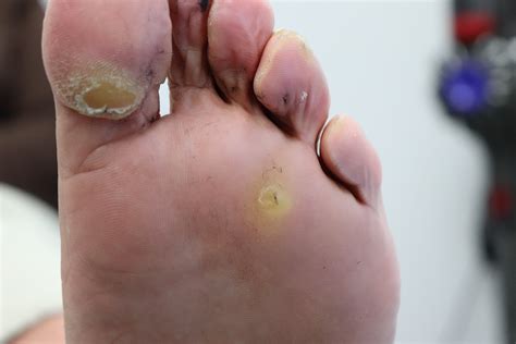 Picture Of Plantar Wart On Ball Of Foot Best Sale | emergencydentistry.com