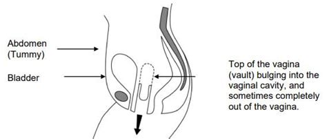 Sacrocolpopexy for Vault Prolapse - Milton Keynes University Hospital