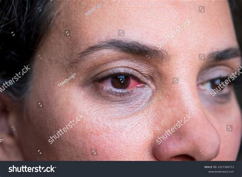 2,519 Eye Surgery Recovery Images, Stock Photos & Vectors | Shutterstock